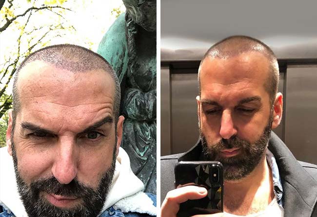 foto 2 mesi dopo il trapianto di capelli zaffiro da 3400 innesti da juergen t.