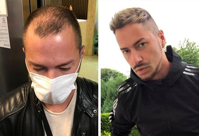 Foto di Prima e dopo il trapianto di capelli DHI con 5200 innesti fatto da andre osiander