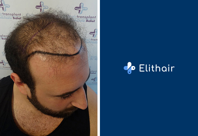 Foto di Prima il trapianto di capelli zaffiro con 3500 innesti fatto da Artin A. Elithair