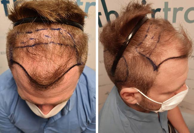 Foto di prima il trapianto di capelli zaffiro da 4500 innesti fatto da Kewin Lenzig