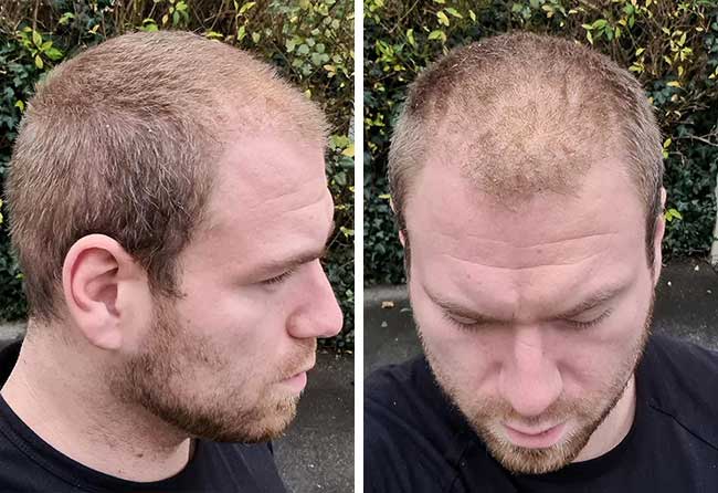 Foto di dopo il trapianto di capelli zaffiro da 4500 innesti fatto da Kewin Lenzig