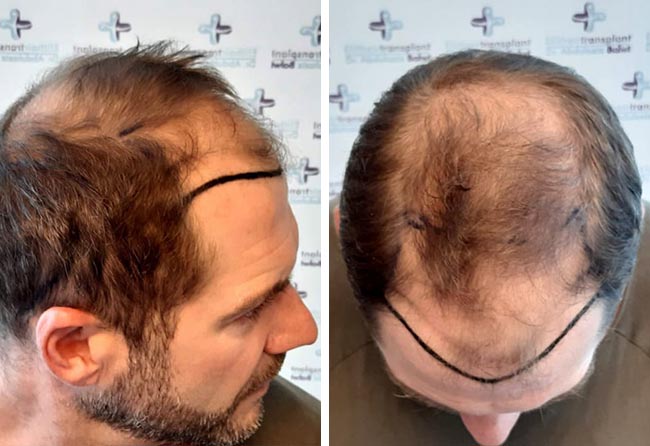 foto prima del trapianto di capelli zaffiro da 4100 innesti fatto da Markus