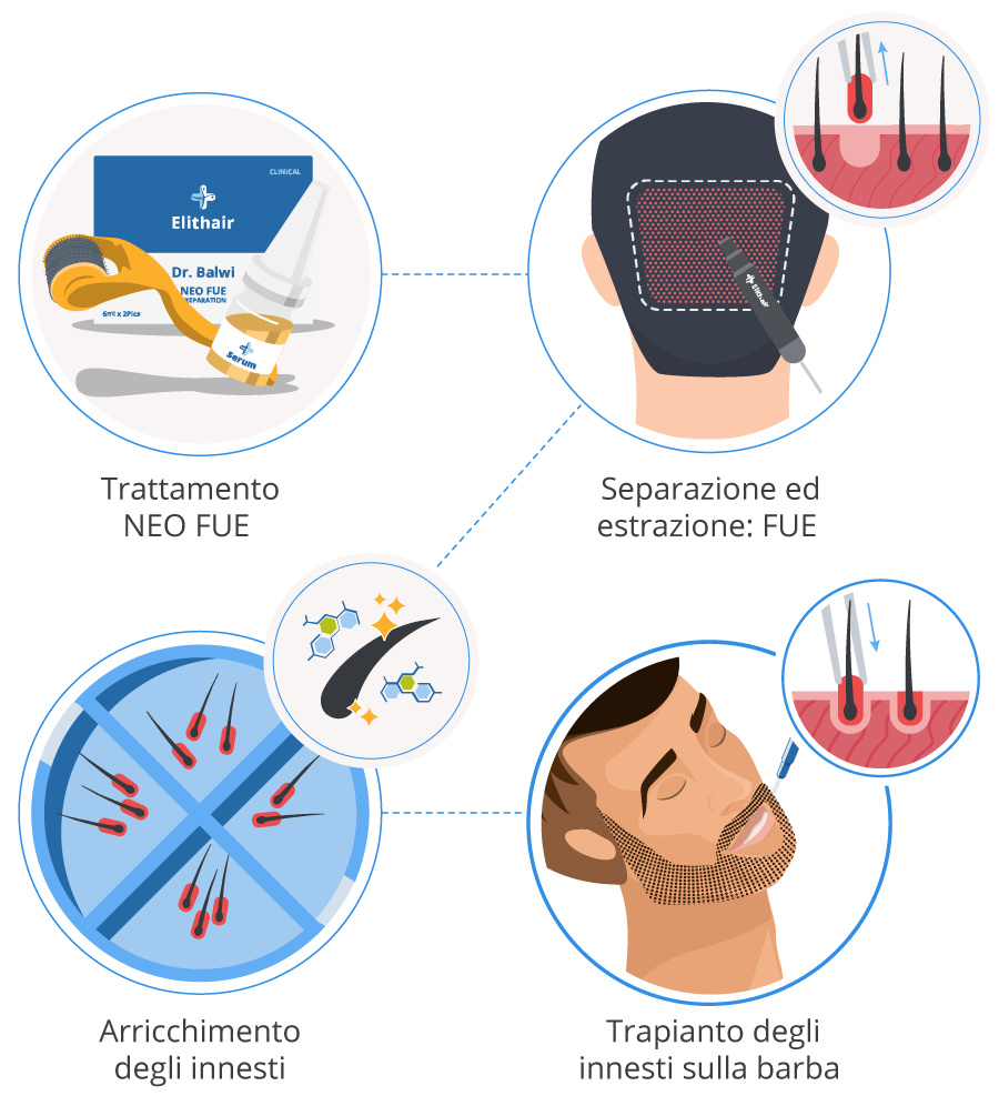 Infografica che mostra tutte le fasi di un trapianto di barba