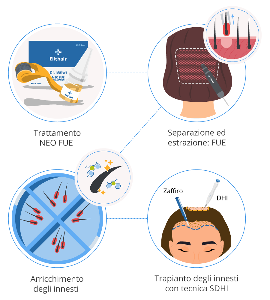 Infografica che mostra le 4 fasi della procedura di un trapianto di capelli per le donne