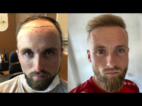 thumbnail prima e dopo un trapianto di capelli in Turchia con Elithair