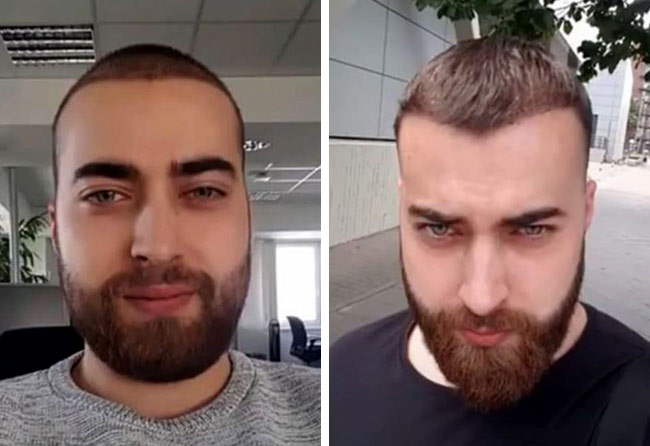 foto del dopo il trapianto di barba zaffiro da 4250 innesti fatto da andre ulbrich passati 4 mesi