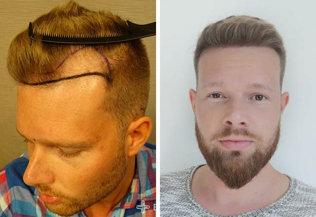 Foto di Prima e dopo il trapianto di capelli zaffiro con 2800 innesti fatto da Alexander Kitzel