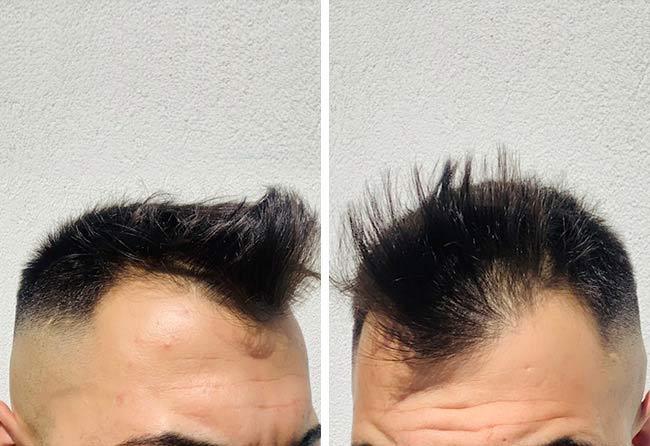 foto prima del trapianto di capelli zaffiro da 2200 innesti fatto da Osmani Perparim