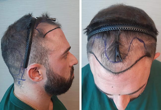 foto del Prima il trapianto di capelli zaffiro da 2700 innesti fatto da kevin wolter