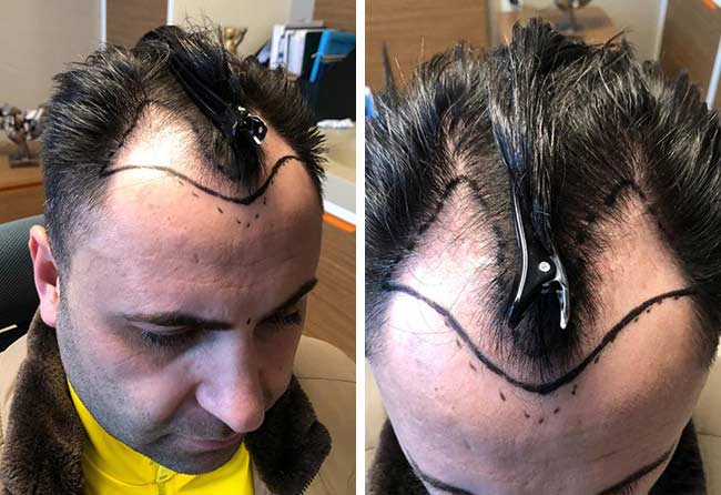 foto prima del trapianto di capelli zaffiro da 4200 innesti fatto da Murat Kizilkaya