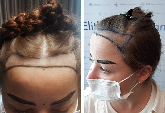 Prima del trapianto di capelli zaffiro da 2600 innesti di Liliana Steinhöffel