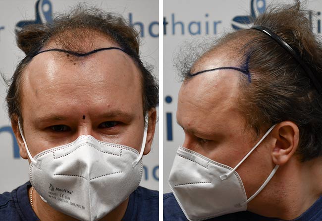 Prima del trapianto di capelli zaffiro da 4200 innesti di Sergej Weresomski