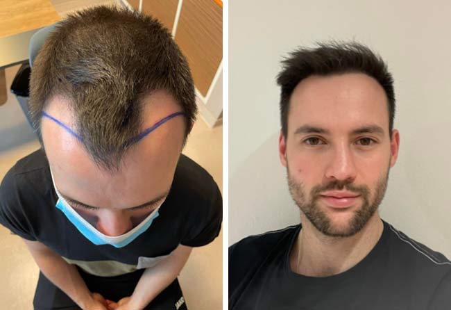 foto prima e dopo il trapianto di capelli zaffiro da 2700 innesti di Thorsten S.