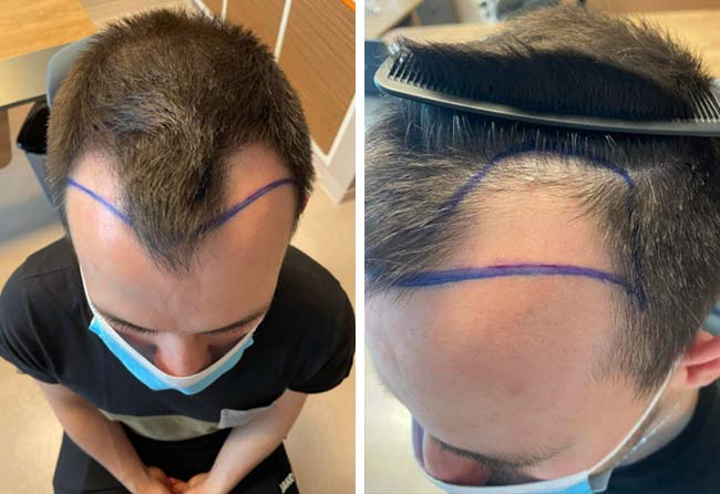 foto di prima il trapianto di capelli zaffiro da 2700 innesti di Alexander Volwerk