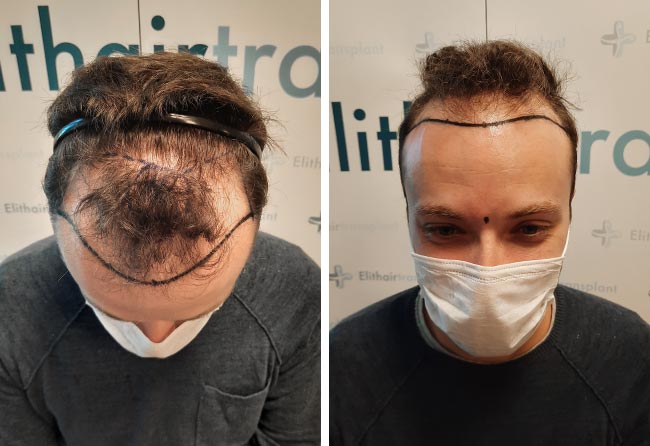 foto di prima il trapianto di capelli zaffiro da 4500 innesti di Didac Scheffler