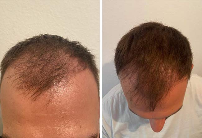 Risultato dopo 3 mesi dal trapianto di capelli zaffiro da 4500 innesti di Sefket Ahmetovic