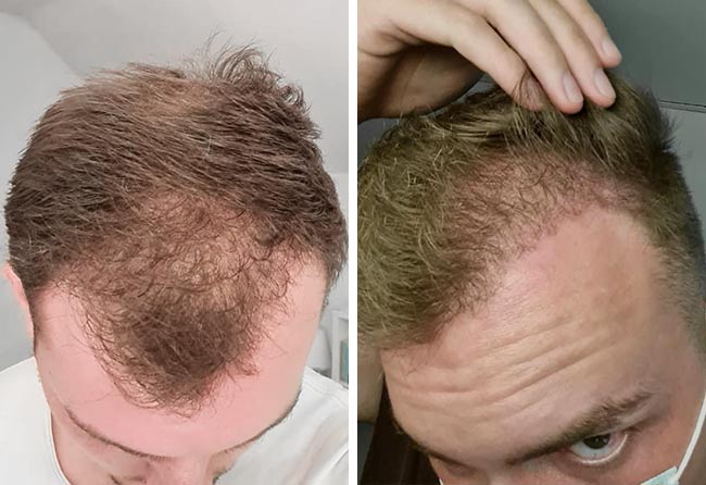 risultato dopo 4 mesi il trapianto di capelli zaffiro da 4200 innesti di Marc Stehr