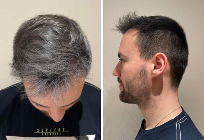 Risultato dopo 5 mesi dal trapianto di capelli zaffiro da 2700 innesti di Thorsten S.