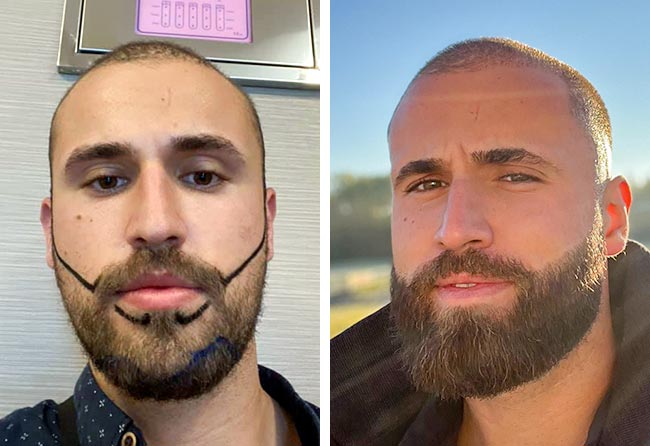 Prima e dopo trapianto di barba zaffiro-3300-grafts-hu-le