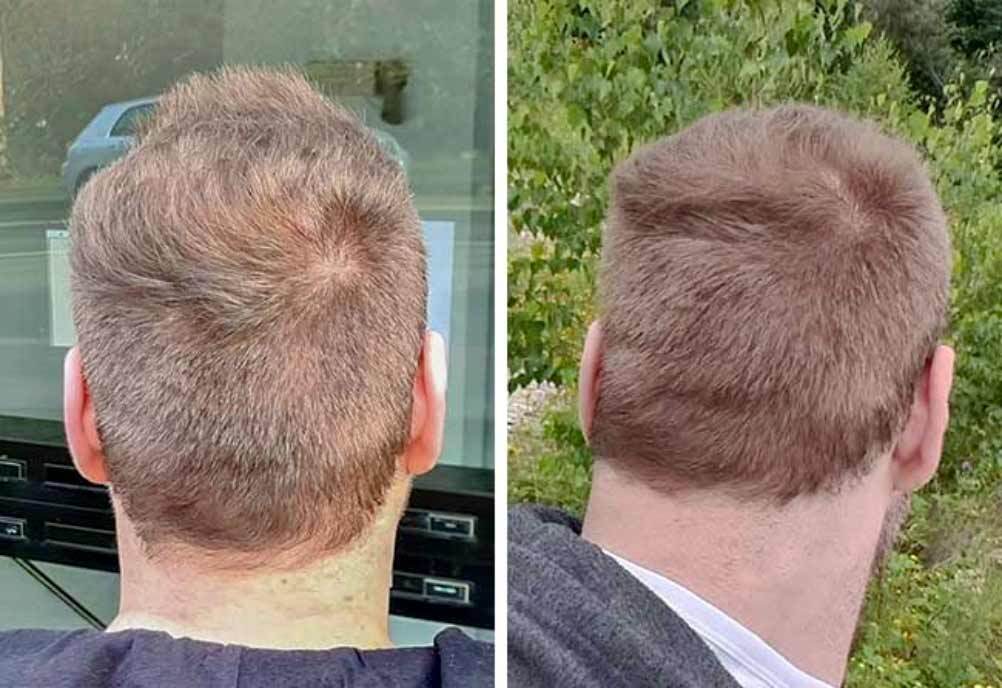 Il paziente Elithair mostra la sua area donatrice dopo il trapianto di capelli