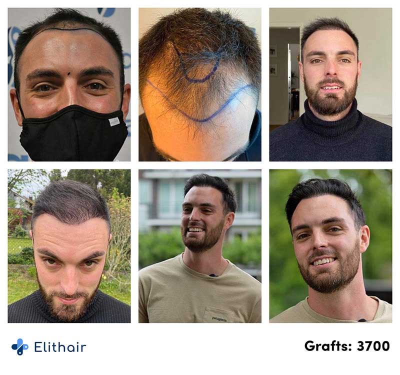 Le foto prima e dopo del trapianto di capelli di Sebastian con 3700 innesti presso Elithair