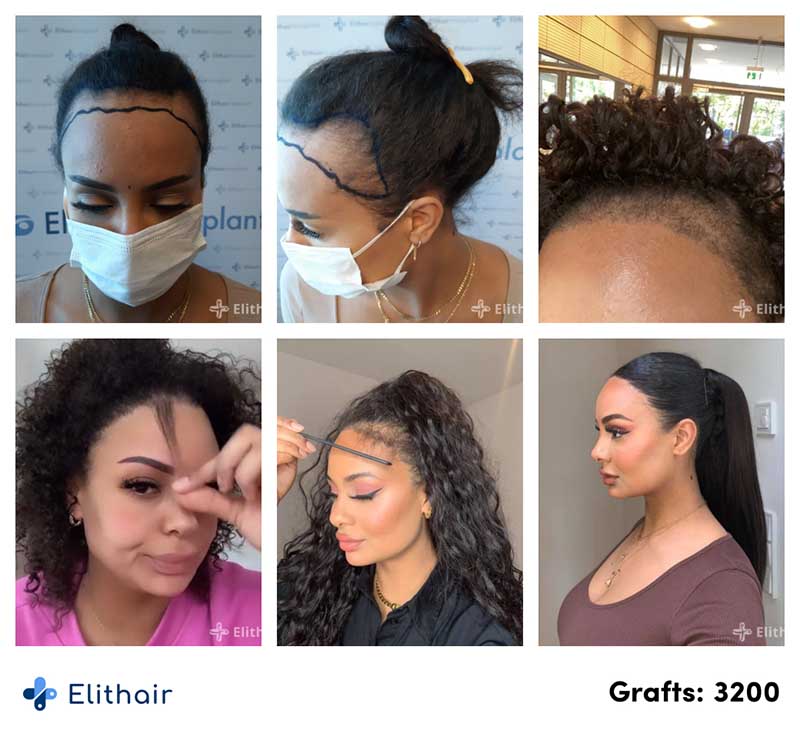 Foto prima e dopo il trapianto di capelli di Jahy C. con 3200 innesti