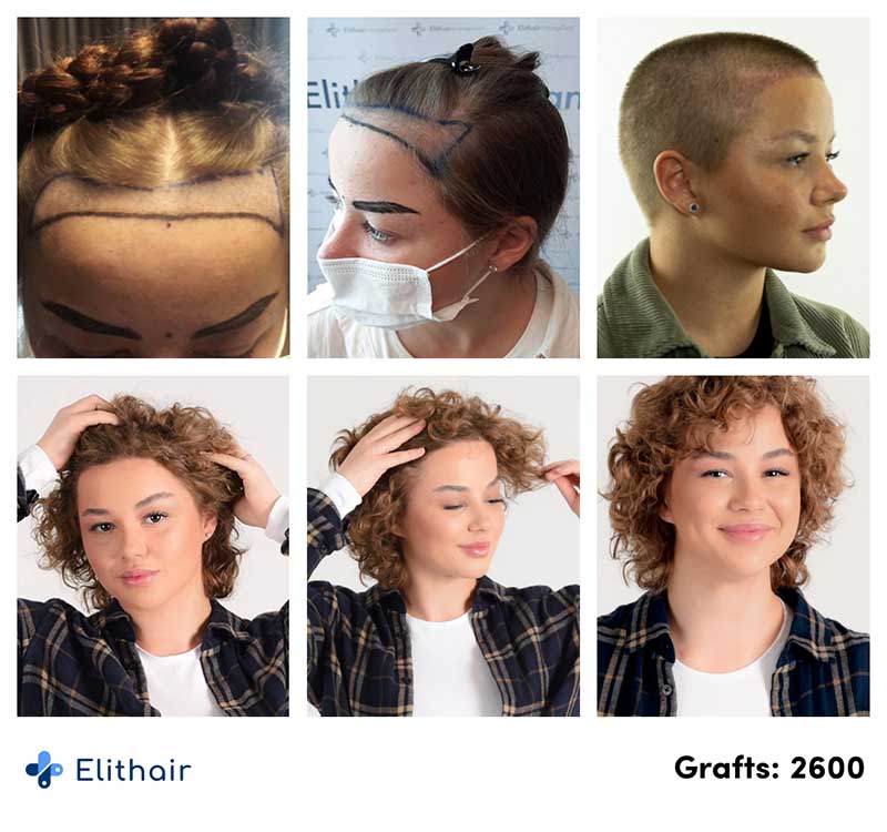 Risultati prima e dopo di un trapianto di capelli su Lilianna, con 2600 innesti presso la clinica Elithair. L'immagine mostra l'aumento della densità e la copertura dei capelli dopo il trattamento