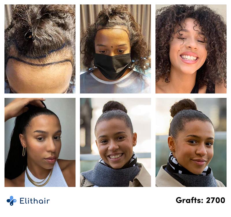 Foto prima e dopo il trapianto di capelli di Melissa con 2700 innesti