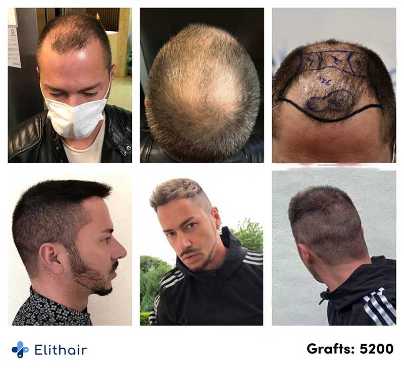 immagine del prima e del dopo del trapianto di capelli FUE di Andre con 5200 innesti