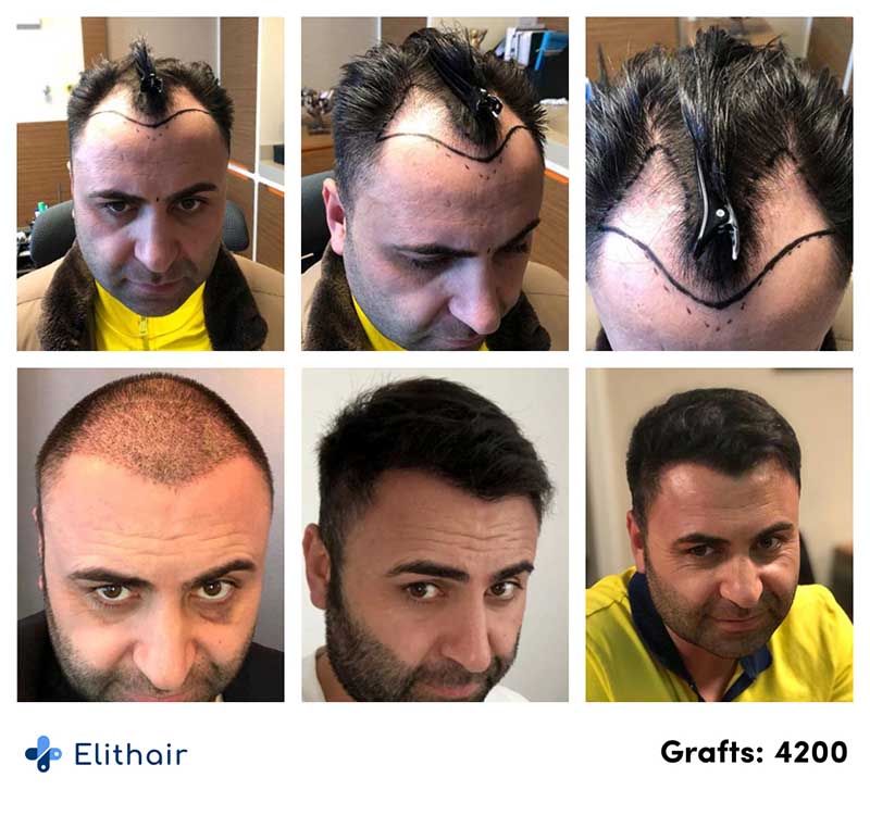 immagine del prima e del dopo del trapianto di zaffiro di Murat con 4200 innesti