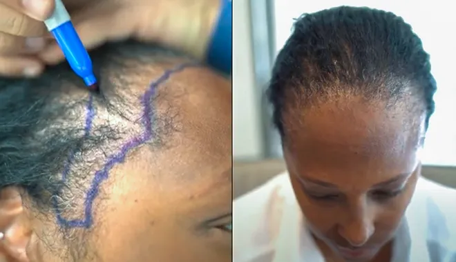 Illustrazione dell'alopecia da trazione e della perdita di capelli causata dalla tensione sui follicoli, trattata presso la clinica Elithair. L'immagine mostra le aree colpite e il tipo di intervento necessario per ripristinare la crescita dei capelli.