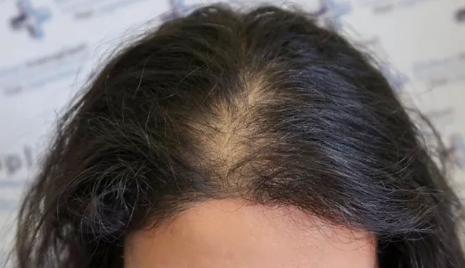 Immagine di capelli sottili in una donna con perdita di densità, valutata presso la clinica Elithair. L'immagine evidenzia la struttura delicata dei capelli e la necessità di trattamento per rinforzarli.