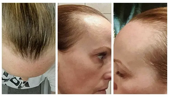 Diagnosi della perdita di capelli in una donna presso la clinica Elithair. L'immagine mostra una specialista che valuta lo stato del cuoio capelluto per determinare il trattamento più adeguato