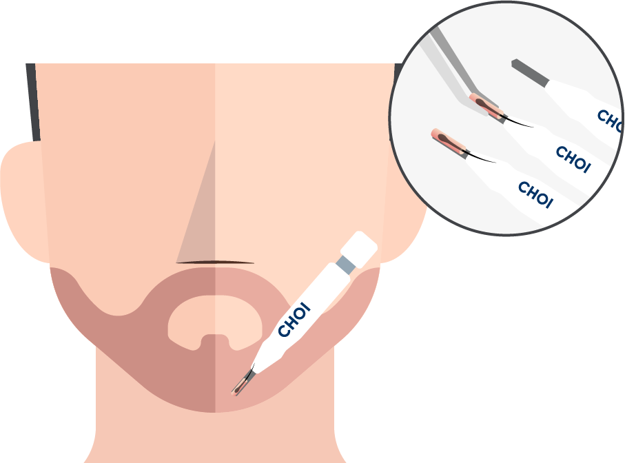 Illustrazione dell'inserimento degli innesti con la tecnica DHI per un trapianto di barba