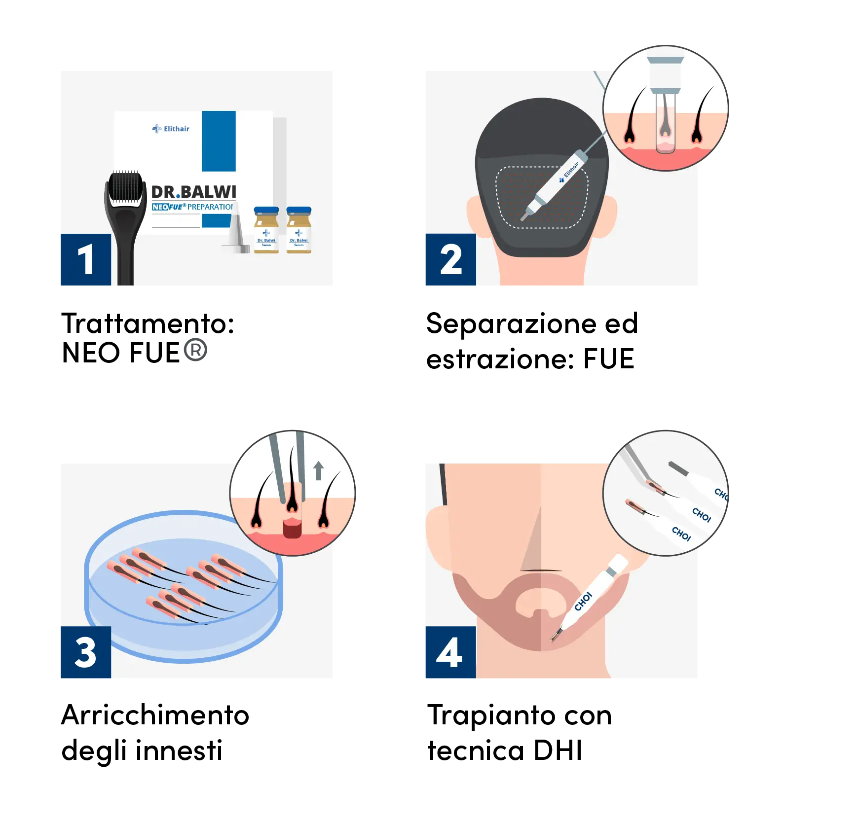 Illustrazione della procedura di un trapianto di capelli DHI